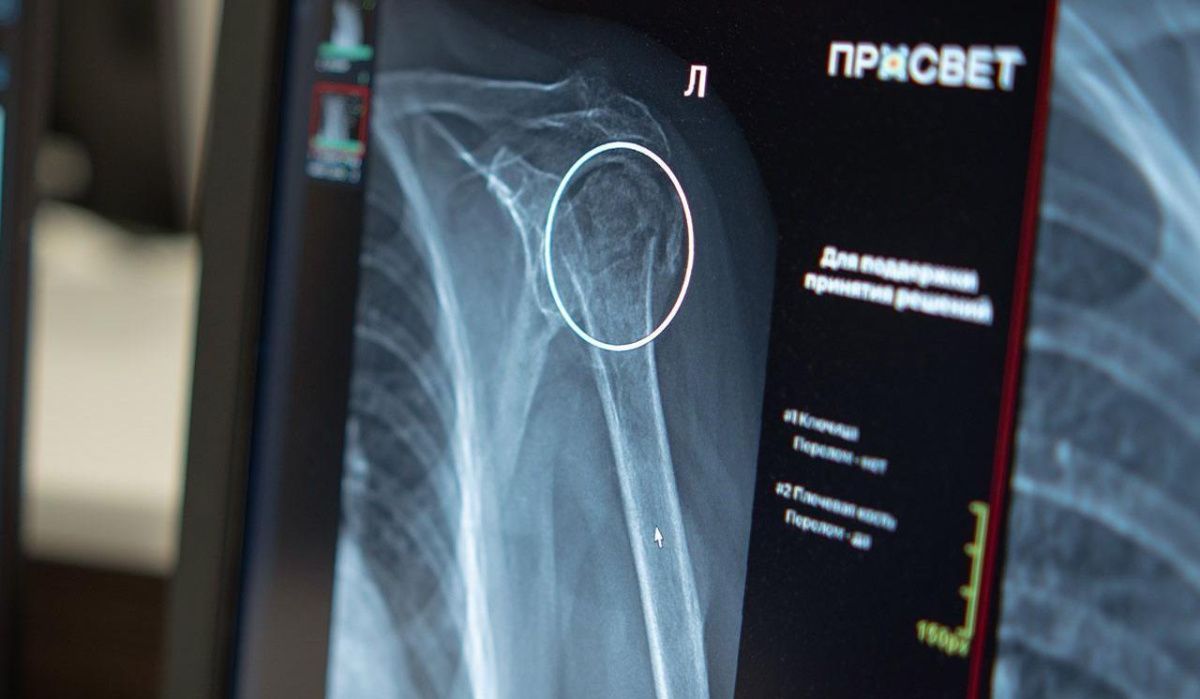 В Москве запущен ИИ-сервис для диагностики переломов плеча